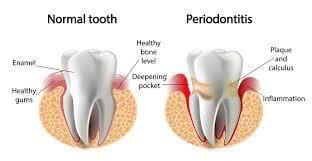 Periodontal Disease Periodontal Disease